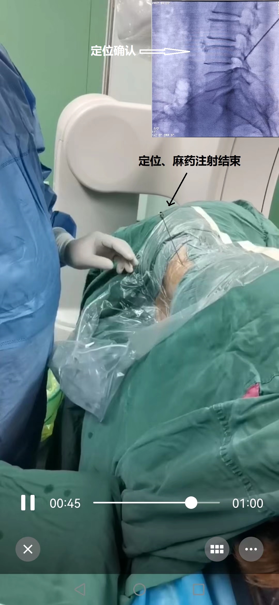 3-定位-麻药注射结束.jpg