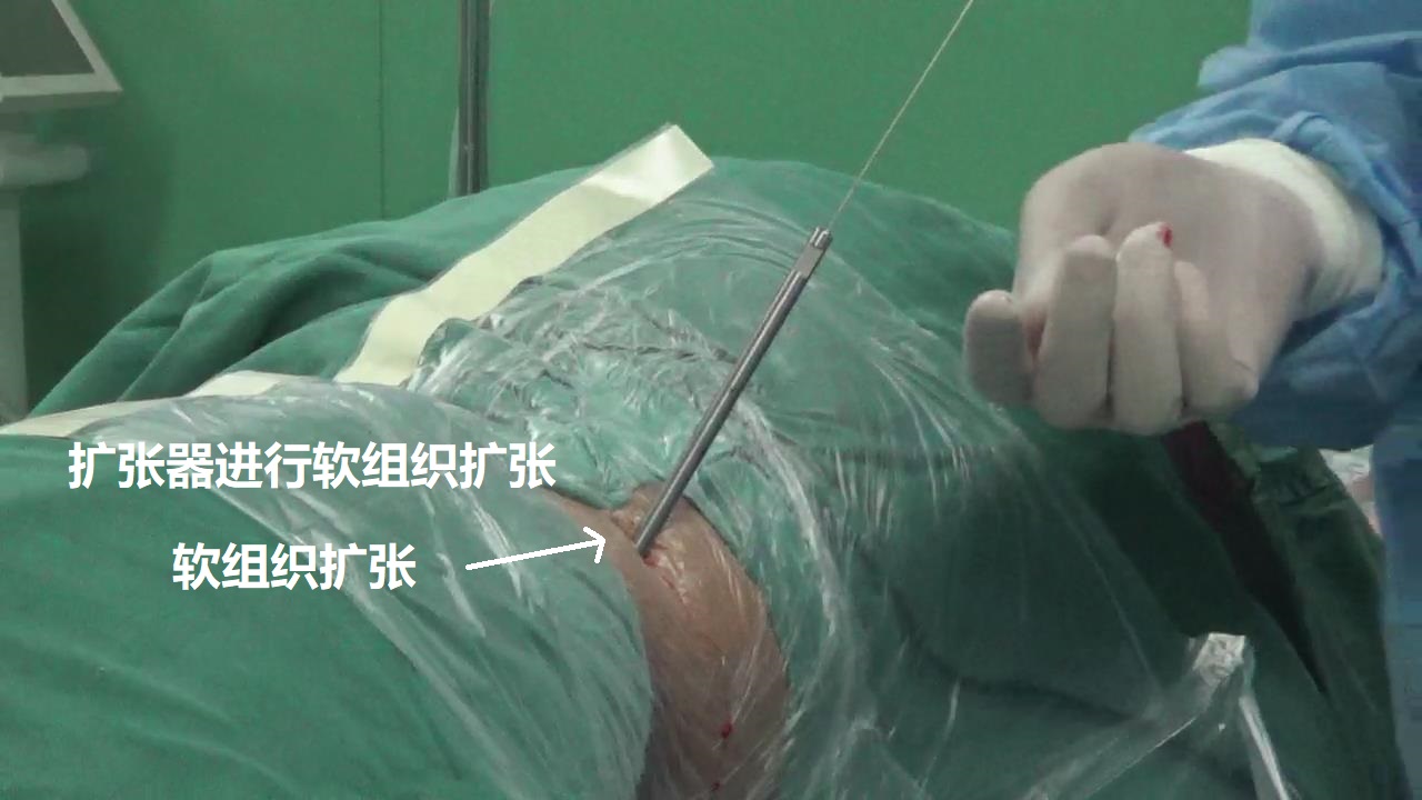 5-扩张器软组织扩张.jpg